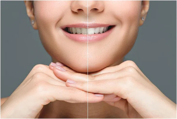 Teeth Cleaning and Whitening