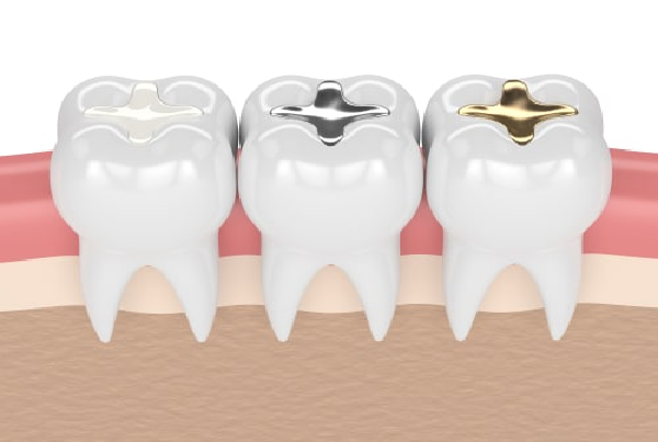 Dental Filling