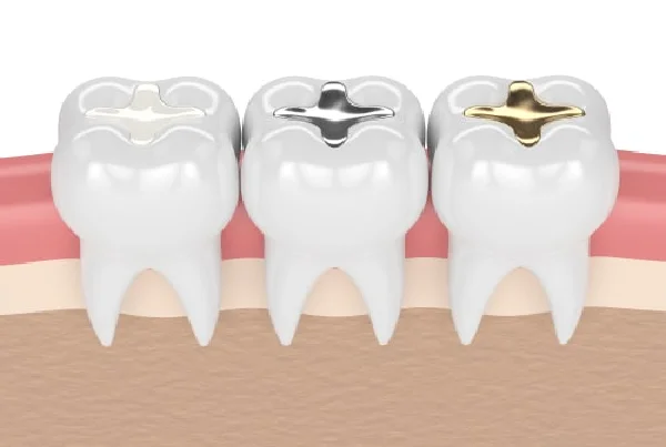Dental Filling