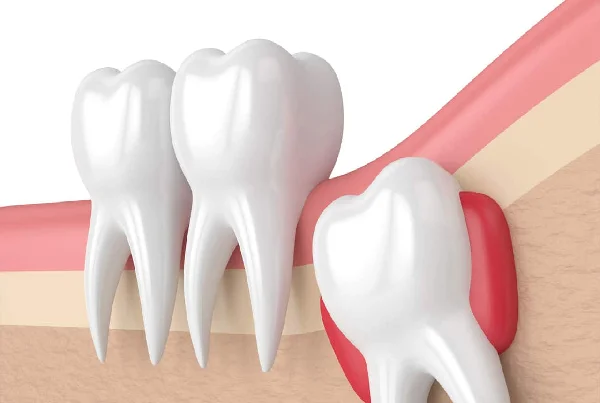Wisdom Tooth Removal